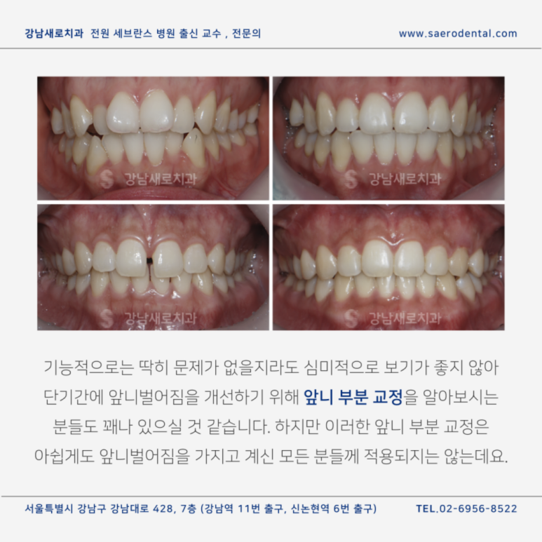 벌어진 앞니 교정으로 단기간에 개선하려면? 관련 이미지 2