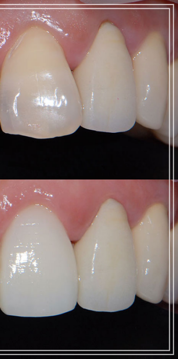 헨리라미네이트, 치아 손상없이 안전하게 진행 관련 이미지 7