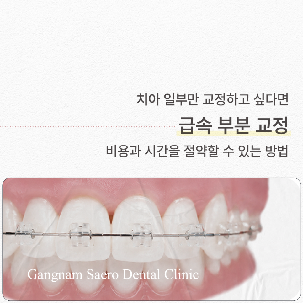 치아 일부만 교정하고 싶다면 비용과 시간을 절약하는 (급속부분교정) 관련 이미지 1