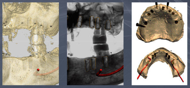 치아가 얼마 안 남은 65세이상임플란트 (전체임플란트후기) 관련 이미지 8
