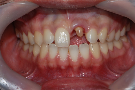 법랑질 삭제를 최소로 하는 헨리라미네이트 관련 이미지 5