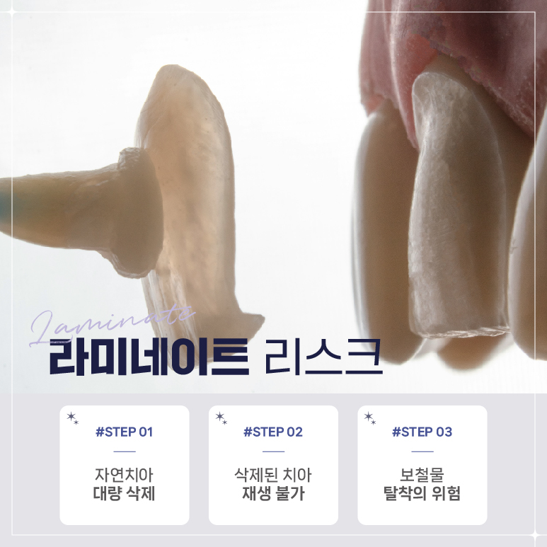 강남역 라미네이트대체 시술 (에어네이트) 관련 이미지 3