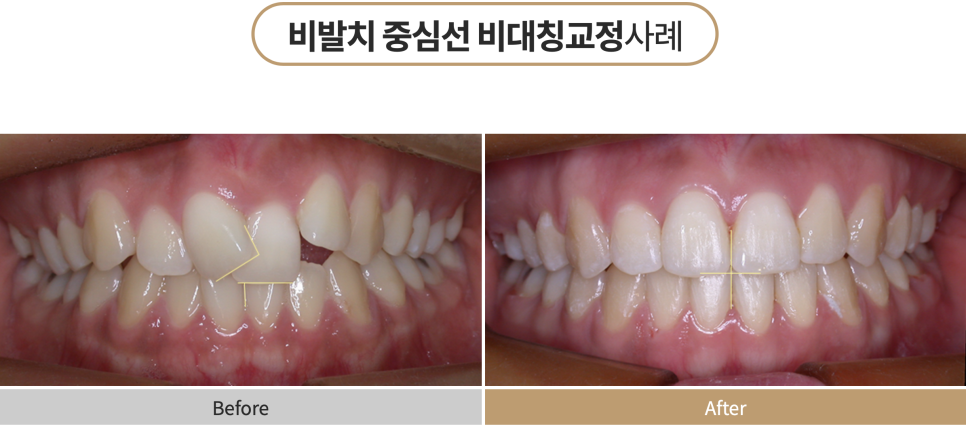 비발치교정치료, 부작용 피하는 방법? 관련 이미지 8