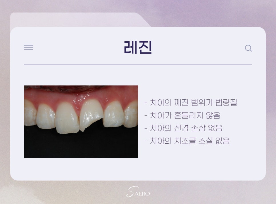 치아크랙 치료 방법? 레진, 라미네이트, 크라운, 임플란트 (앞니깨졌을때) 관련 이미지 4
