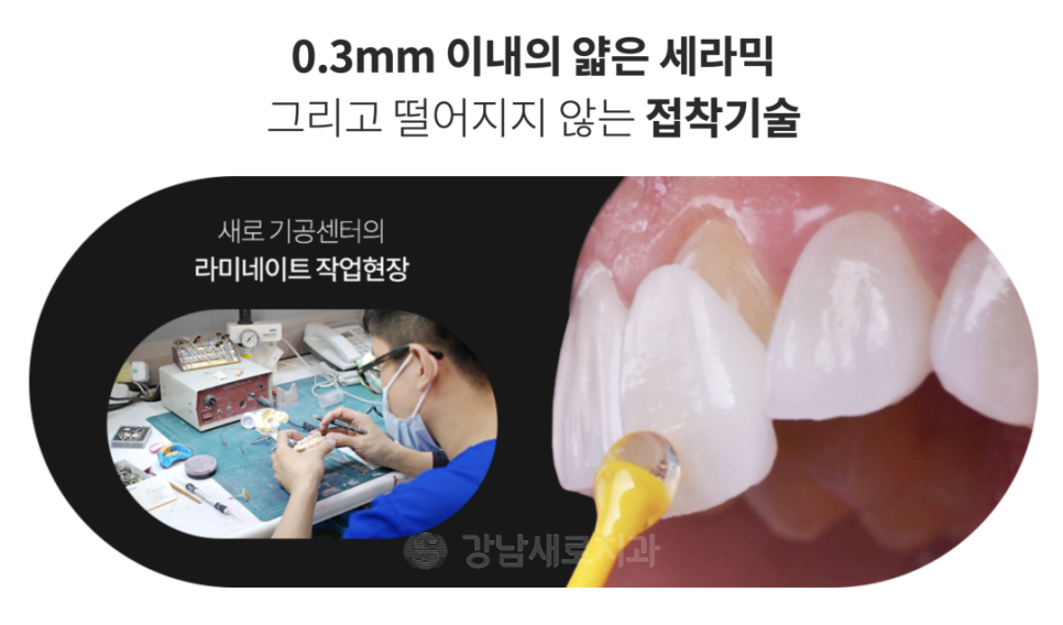 연예인라미네이트, 강남새로치과만의 특별한 방법? 관련 이미지 9