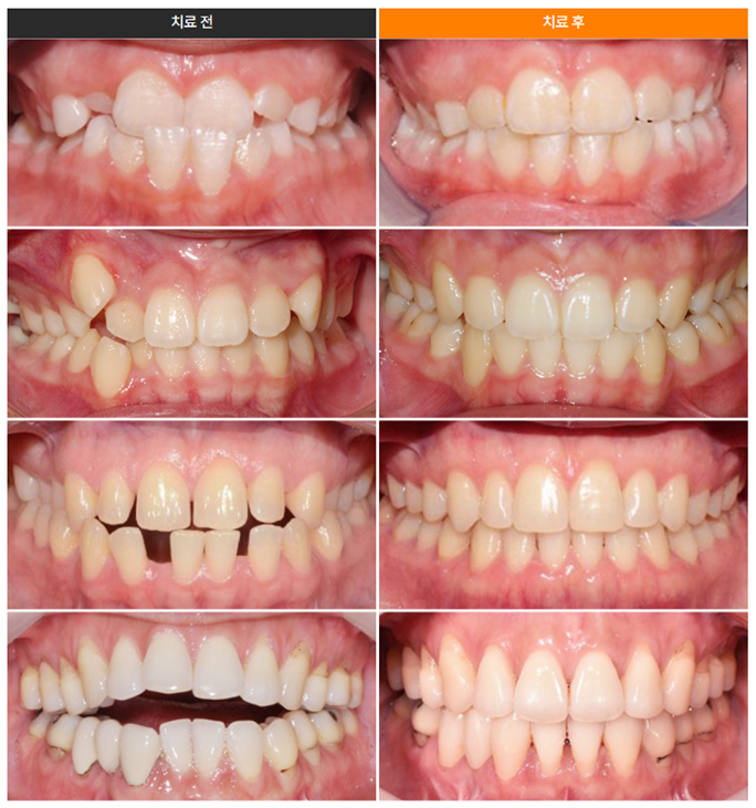 부정교합 투명교정 (1~3급 부정교합 개방교합 과개교합 인비절라인 나노라이너) [ 강남새로치과 ] 관련 이미지 13