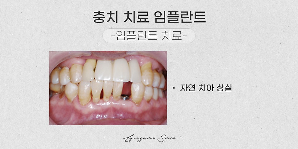 충치 치료 방법 때우기 씌우기 임플란트 (충치치료임플란트) 관련 이미지 4