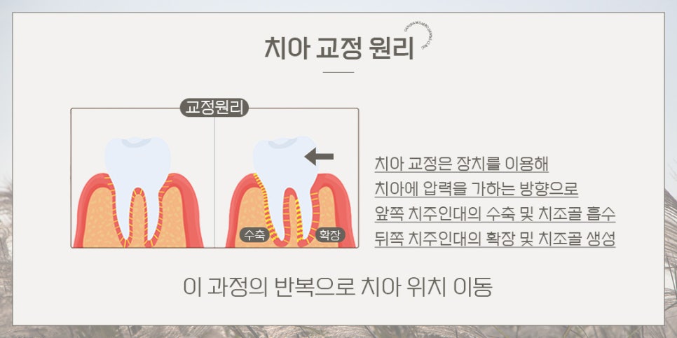 연예인 교정 후 얼굴 변화? (교정얼굴변화) 관련 이미지 2