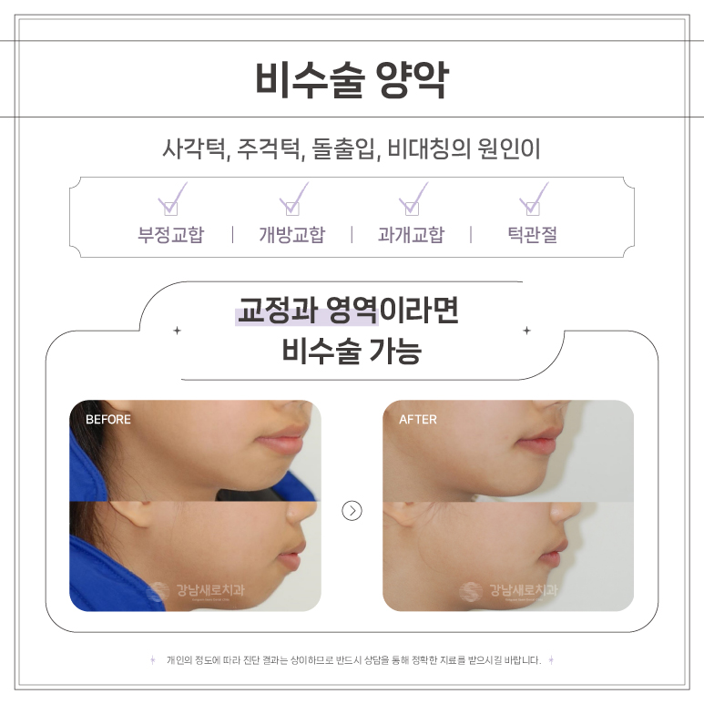 연예인 교정 얼굴 작아지는 법 (교정을 하면 얼굴형이 달라지나요?) [ 강남새로치과 ] 관련 이미지 4