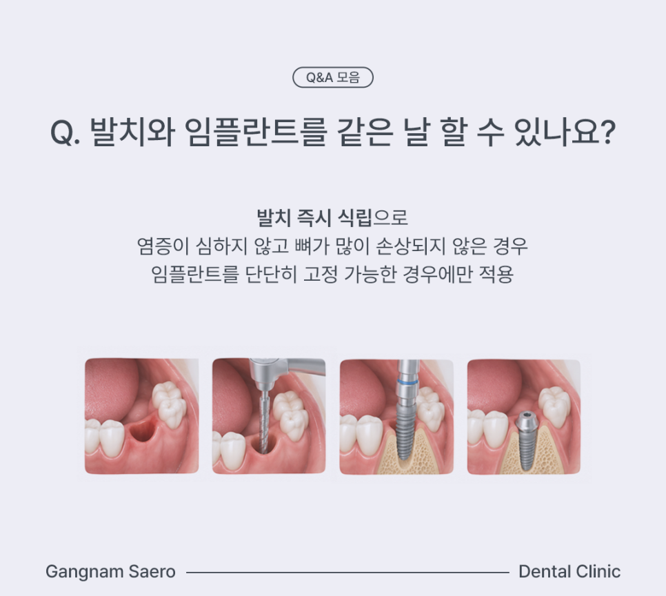임플란트 자주하는 질문 통증, 기간, 뼈이식 Q&A모음 관련 이미지 4