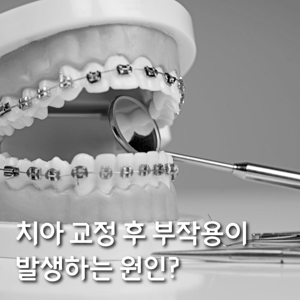 치아 교정 후 부작용이 발생하는 원인? 관련 이미지 1