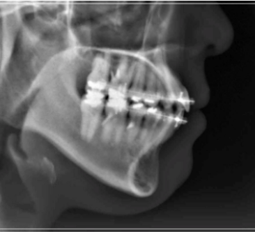 입 안 다물어짐 수술 없이 해결하는 방법 관련 이미지 10