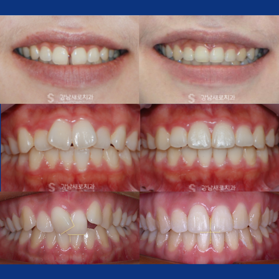 벌어진앞니 교정 치료, 발치 없이 진행하려면? 관련 이미지 6