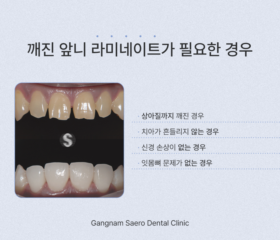앞니깨졌을때, 깨진앞니 치료하는 여러 가지 방법 레진 / 라미네이트 / 크라운 / 임플란트 관련 이미지 5