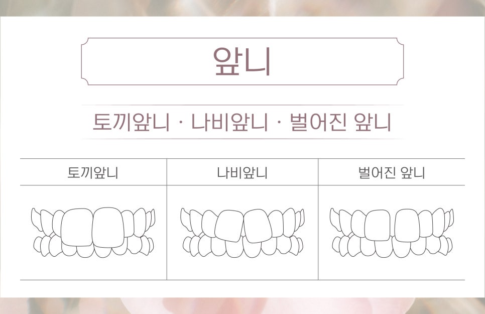 (부정교합 / 앞니 / 잇몸) 비수술 치과성형 관련 이미지 4