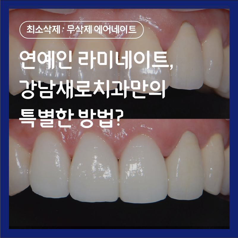 연예인라미네이트, 강남새로치과만의 특별한 방법? 관련 이미지 6