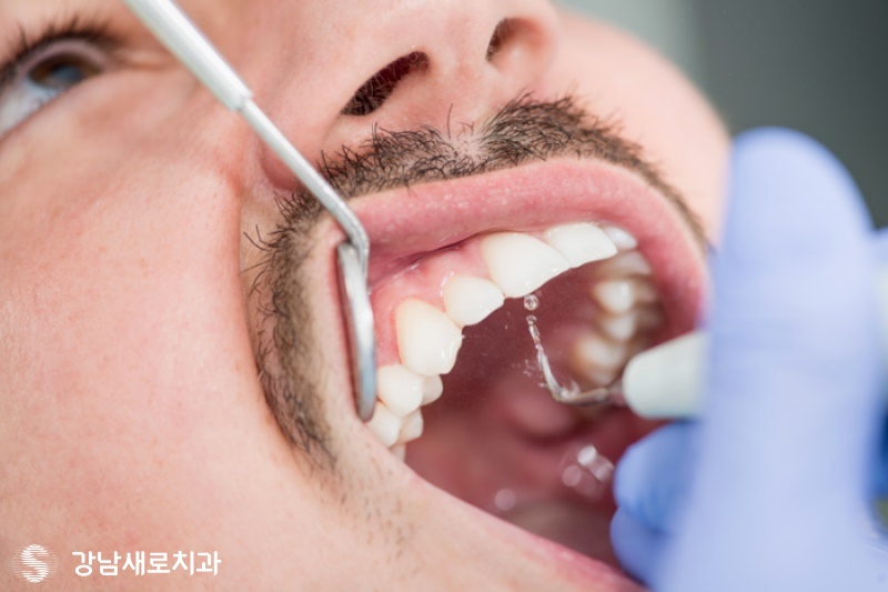 강남역잇몸염증치료, 잇몸피가 나는 원인의 치료방법? 관련 이미지 2