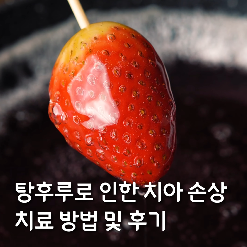 탕후루 치아 손상을 유발? 치료 방법 및 후기 관련 이미지 1