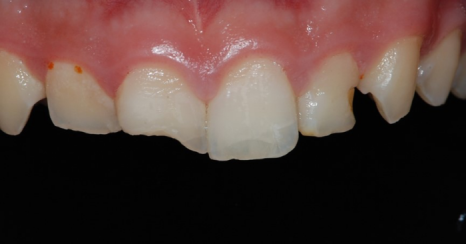 법랑질 삭제를 최소로 하는 헨리라미네이트 관련 이미지 10