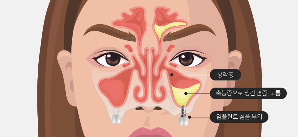 임플란트 안전한 결과를 위하여 [ 상악동거상술 ] [ 강남새로치과 ] 관련 이미지 4