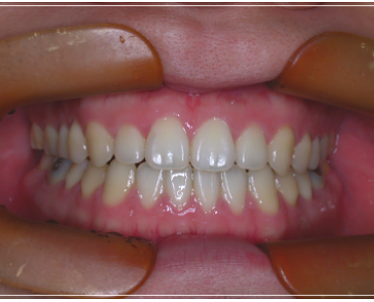 입 안 다물어짐 수술 없이 해결하는 방법 관련 이미지 7