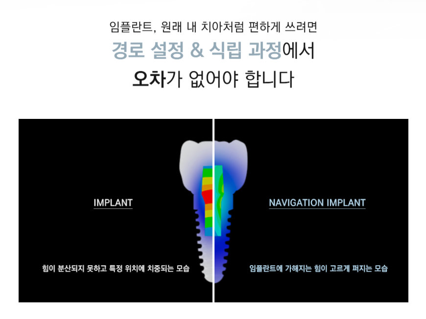 임플란트부작용 걱정된다면 강남새로치과 네비게이션 임플란트 (임플란트통증) 관련 이미지 2