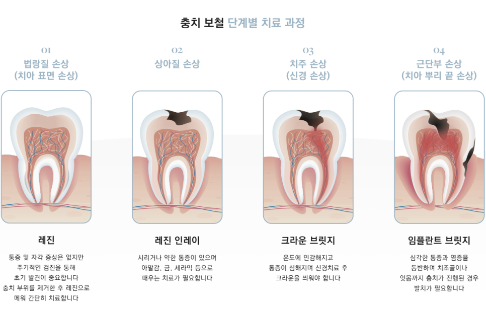 충치때우기 충치씌우기 차이, 크라운을 미루면 임플란트까지?! 관련 이미지 5