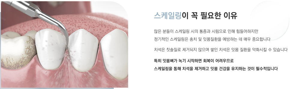 역 도보 5분 근처치과 진료목록 (강남새로치과) 관련 이미지 6