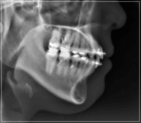 입안다물어짐 비수술로 해결이 가능하다면 관련 이미지 7