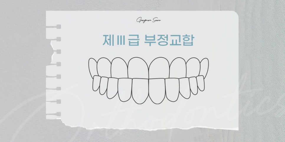 비수술 부정교합을 위한 치과 교정 (투명교정부정교합) 관련 이미지 6