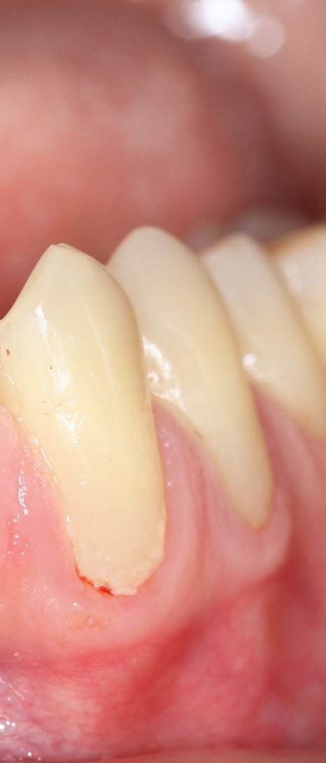 구강질환을 예방하는 치주질환치료 관련 이미지 3