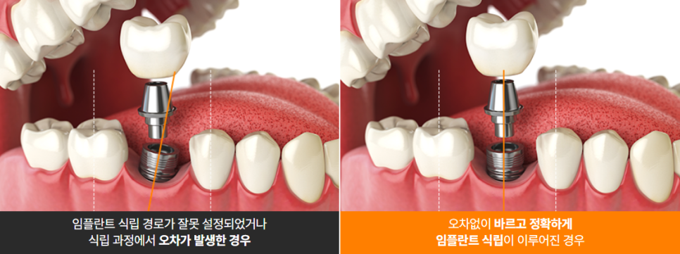 임플란트붓기 출혈 통증 걱정된다면 (네비게이션 임플란트) 관련 이미지 1