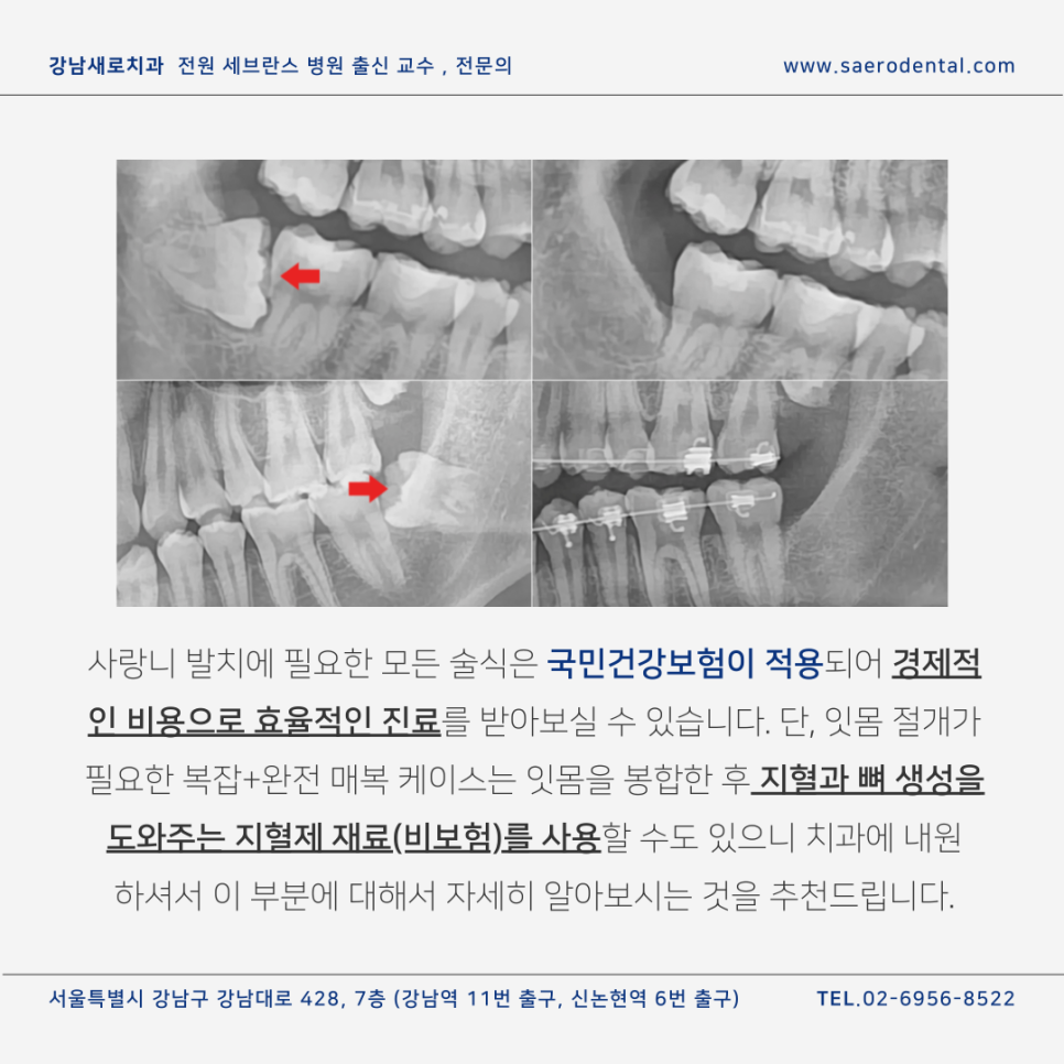 강남사랑니치과, 매복사랑니를 더욱 효율적으로 발치하려면 관련 이미지 9