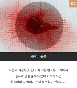 강남역근처치과 사랑니부작용 (사랑니발치) 관련 이미지 4