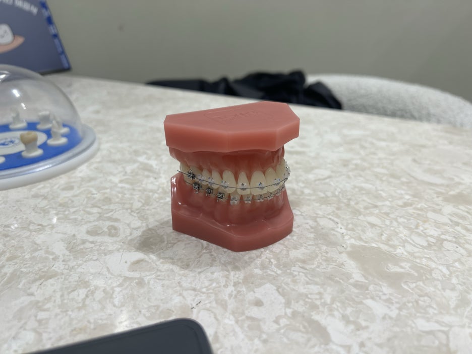 치아 교정을 받고 싶은 분들 주목! 치료 시기와 기간 알려드립니다! 관련 이미지 3