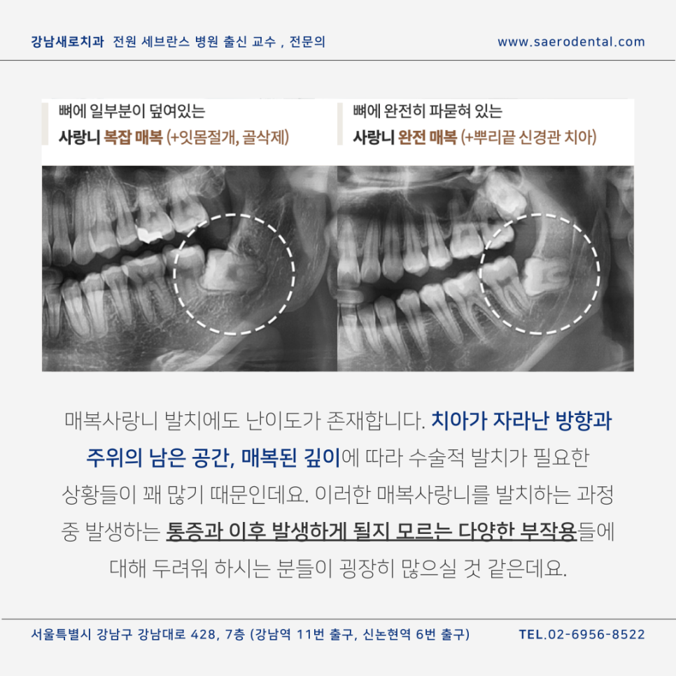 강남사랑니치과, 매복사랑니를 더욱 효율적으로 발치하려면 관련 이미지 6