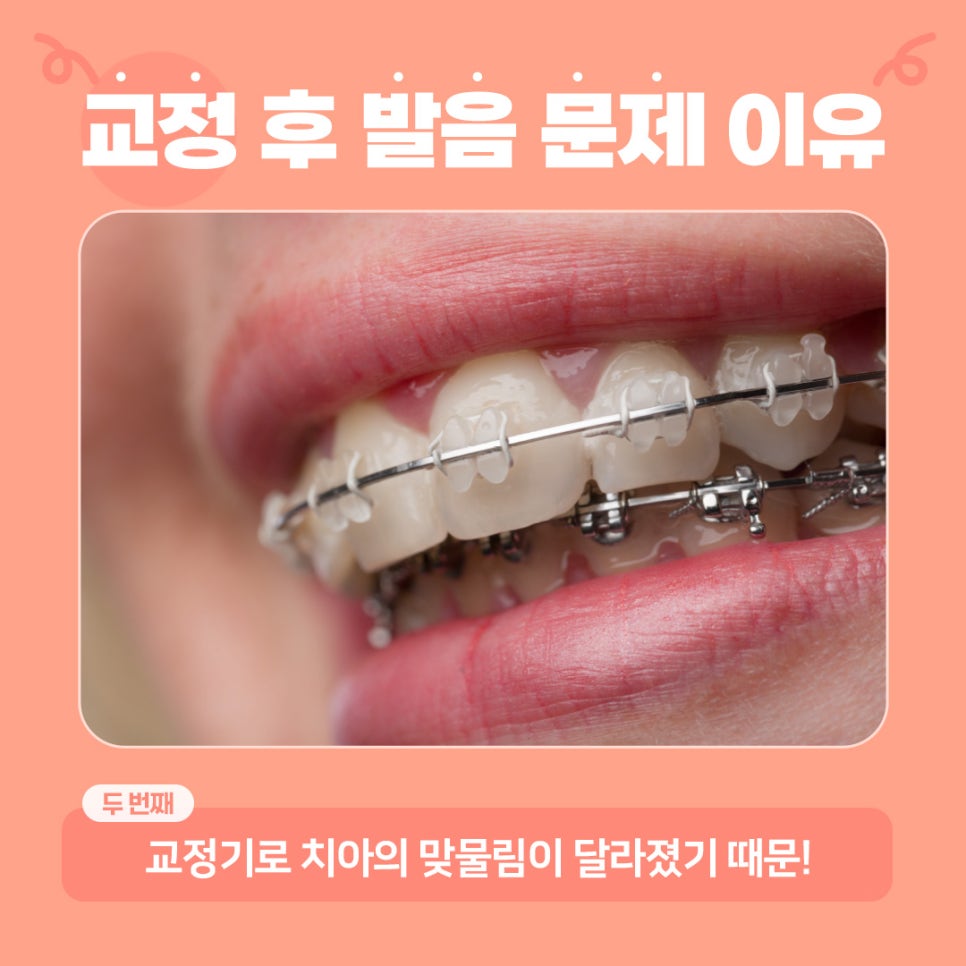 치아교정하면 발음이 안 좋아지나요? (치아교정발음) 관련 이미지 3
