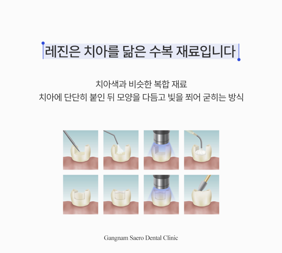 앞니가 깨지거나 벌어졌다면? 레진 치료 안내 관련 이미지 2
