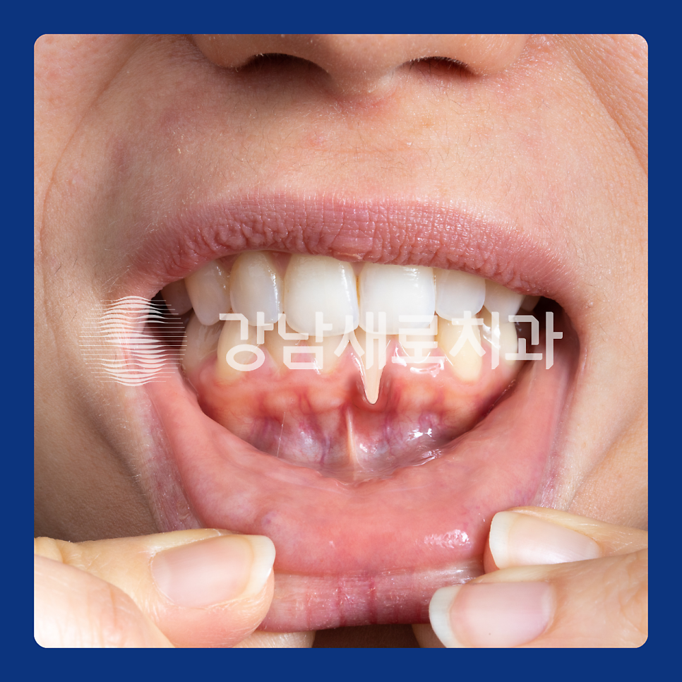 치아 교정 후 부작용이 발생하는 원인? 관련 이미지 6