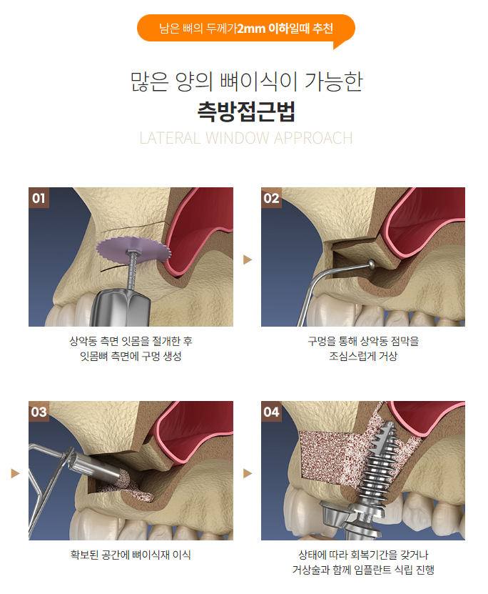 부모님세대 5060을 위한 임플란트 (상악동거상, 당뇨, 고혈압, 골다공증, 무치악 임플란트) 관련 이미지 4
