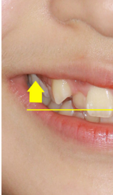 송곳니 덧니 교정없이 방치하면 발생하는 문제? 관련 이미지 6