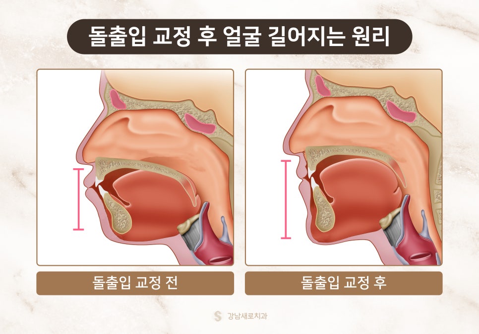 교정 부작용 자세히 알아보기 - 얼굴 변화 원리와 이유 [ 예방 및 대처 방법 ] [ 강남새로치과 ] 관련 이미지 4