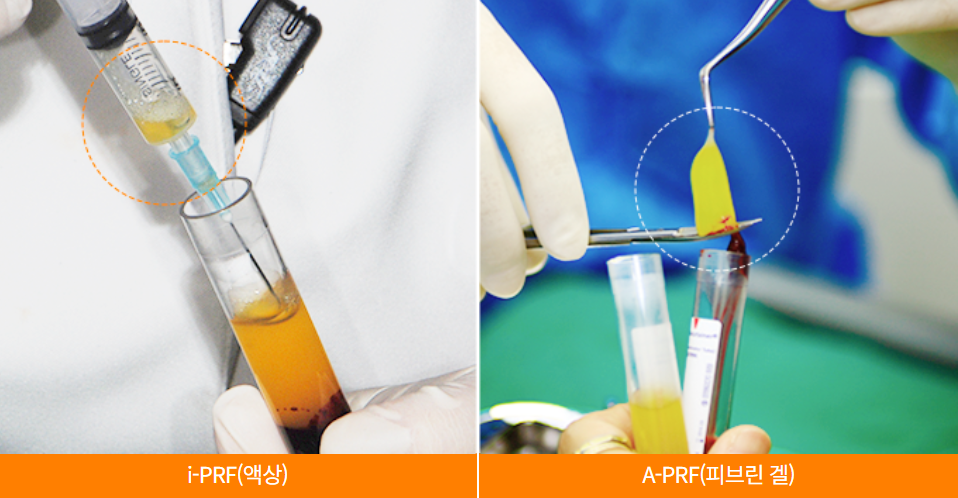 당뇨, 고혈압, 골다공증 임플란트수술 은? (PRF임플란트 자가혈임플란트) 관련 이미지 3