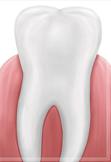헨리라미네이트, 치아 손상없이 안전하게 진행 관련 이미지 5
