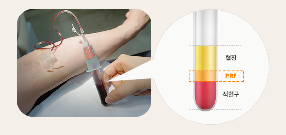 부모님세대 5060을 위한 임플란트 (상악동거상, 당뇨, 고혈압, 골다공증, 무치악 임플란트) 관련 이미지 6