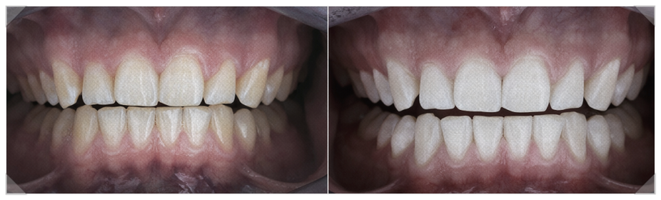 누런 앞니가 고민이라면? 원인과 해결 방법 관련 이미지 1