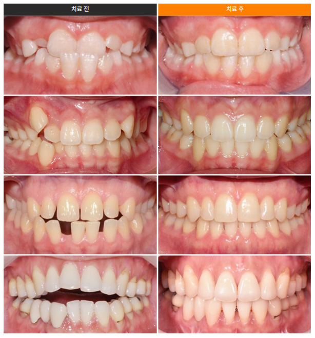 투명교정종류 자세히 알아보기 (1) 인비절라인 관련 이미지 3
