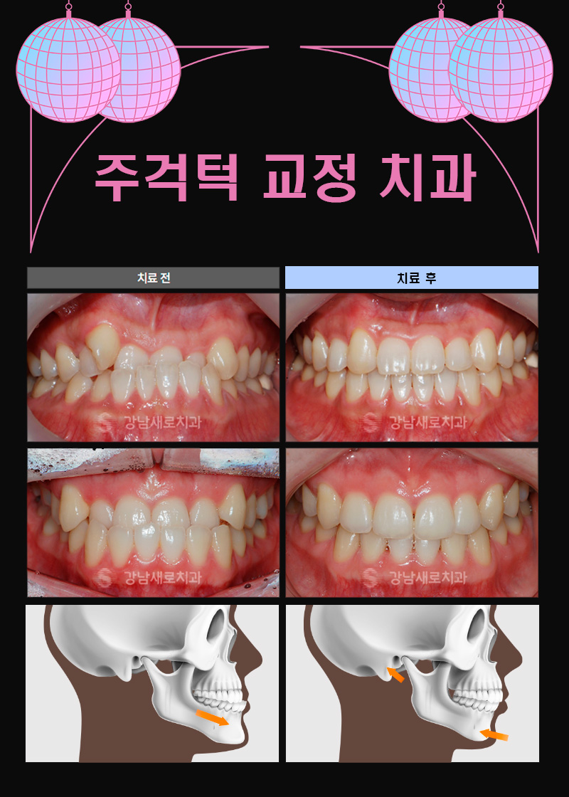 성인 주걱턱 수술 없이 비수술로 (성인 주걱턱교정) 관련 이미지 5