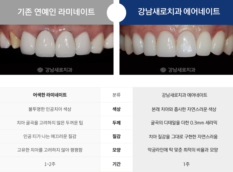 연예인라미네이트, 강남새로치과만의 특별한 방법? 관련 이미지 10