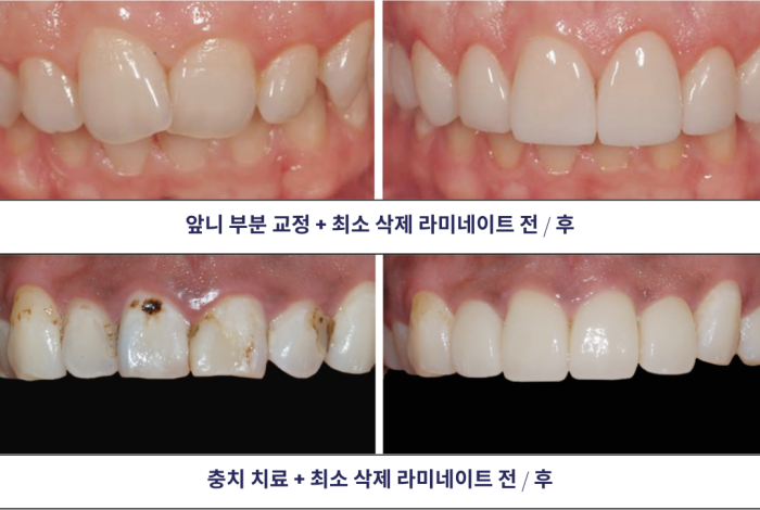 연예인라미네이트, 강남새로치과 에어네이트 관련 이미지 12